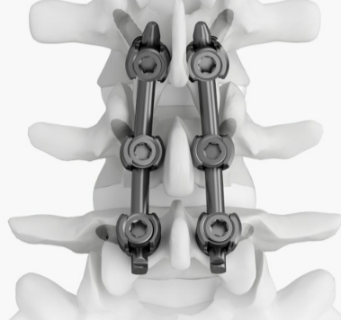 脊柱后路內固定系統貝思達