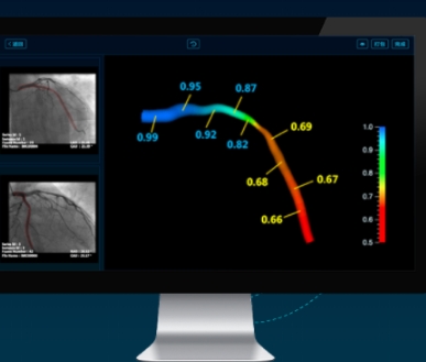 DEEPVESSEL FFR 冠脈血流儲備分數計算軟件科亞