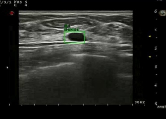 Yizhun DU-C 超聲影像數據處理軟件醫準