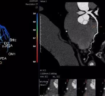 ADAS 3D沃華心血管圖像處理軟件