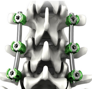美敦力脊柱內(nèi)固定系統(tǒng)組件