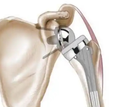 史賽克人工肩關節系統