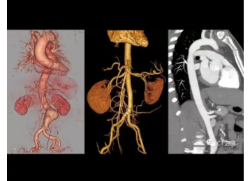 3Daorta 主動脈CT影像處理軟件